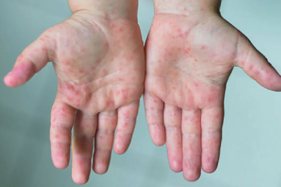 ২৪ ঘন্টায় হাম ও উপসর্গে ৯ জনের মৃত্যু