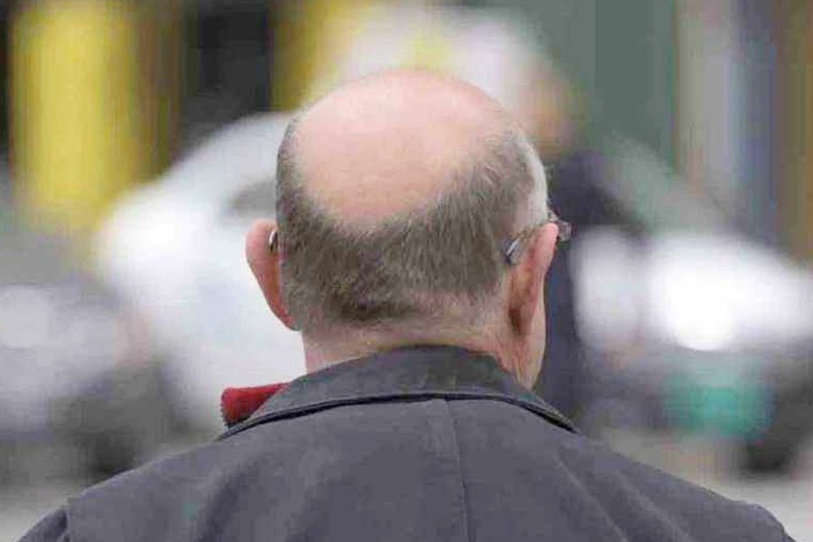 টাক পড়া সমস্যা নিয়ে আর দুঃখ থাকবে না