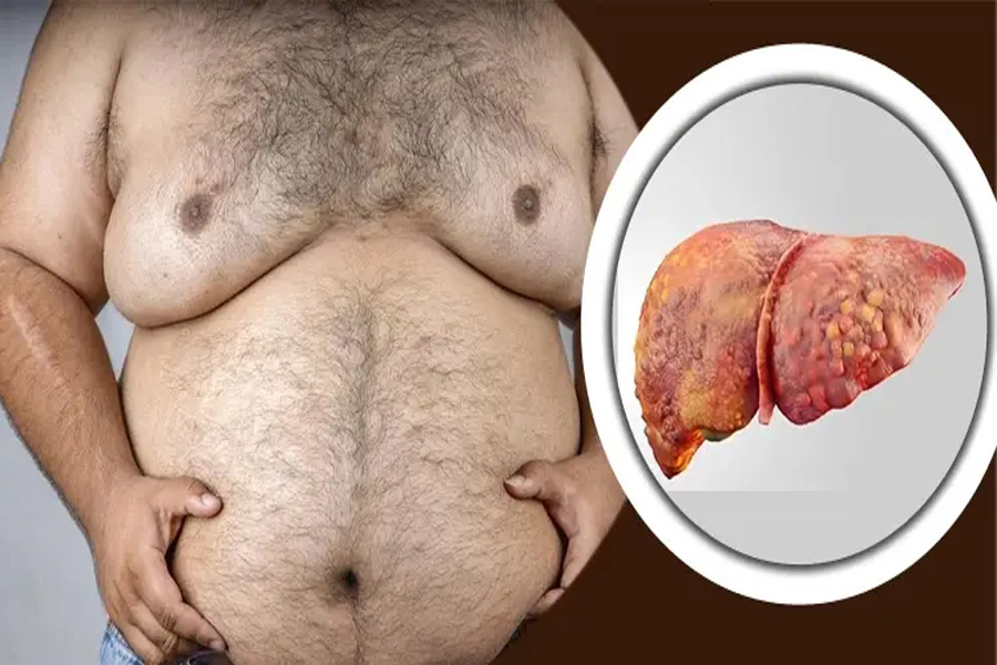 এক পানীয়তেই কমবে ফ্যাটি লিভারের ঝুঁকি