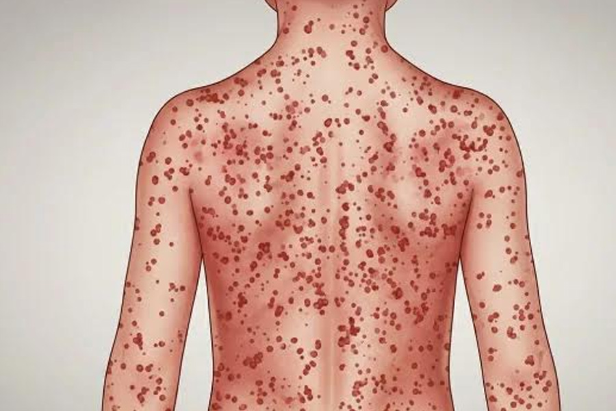 রাজশাহী বিভাগে হামের হটস্পট ২৬, প্রাপ্তবয়স্করাও আক্রান্ত