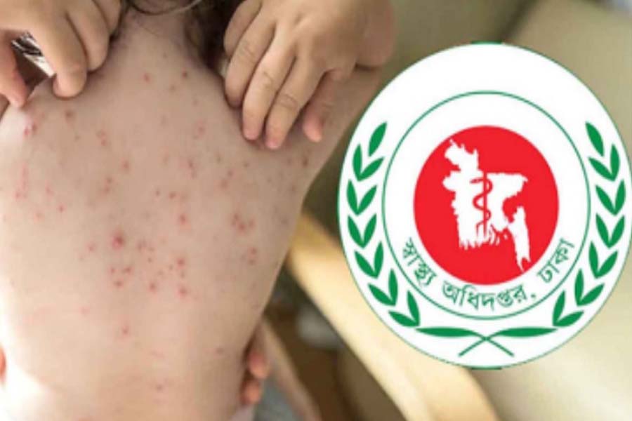 দেশে হাম ও উপসর্গে আরও ৫ মৃত্যু