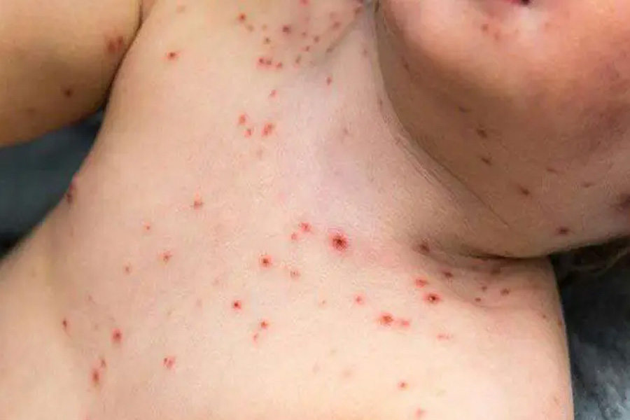 রাজশাহীসহ বিভিন্ন জেলায় যে কারণে বাড়ছে হামের প্রাদুর্ভাব