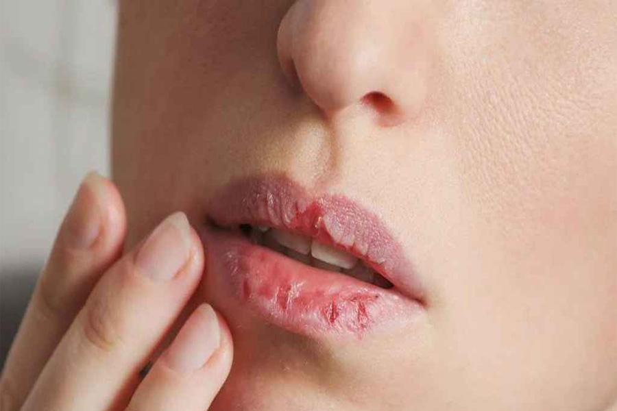 শীতে ঠোঁট ও মুখে ঘা? ঘরোয়া উপায়েই মিলবে আরাম