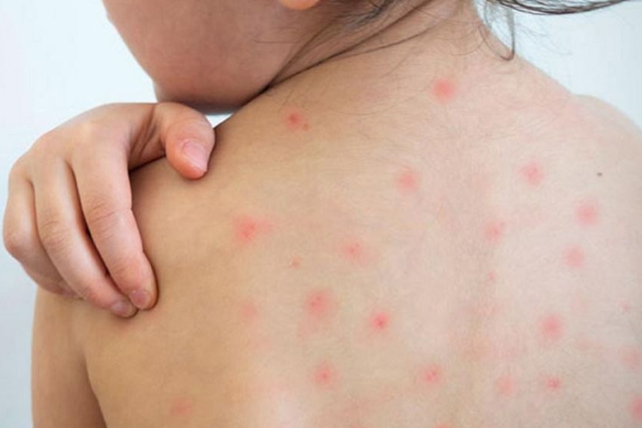 হামের উপসর্গ নিয়ে ২৪ ঘণ্টায় ৪ জনের মৃত্যু