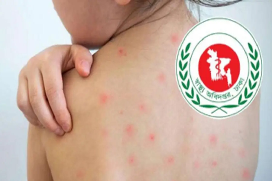হাম ও উপসর্গে দেশে আরো ১০ শিশুর মৃত্যু