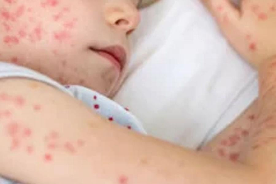 একদিনে হাম ও উপসর্গ নিয়ে আরো ১১ জনের মৃত্যু