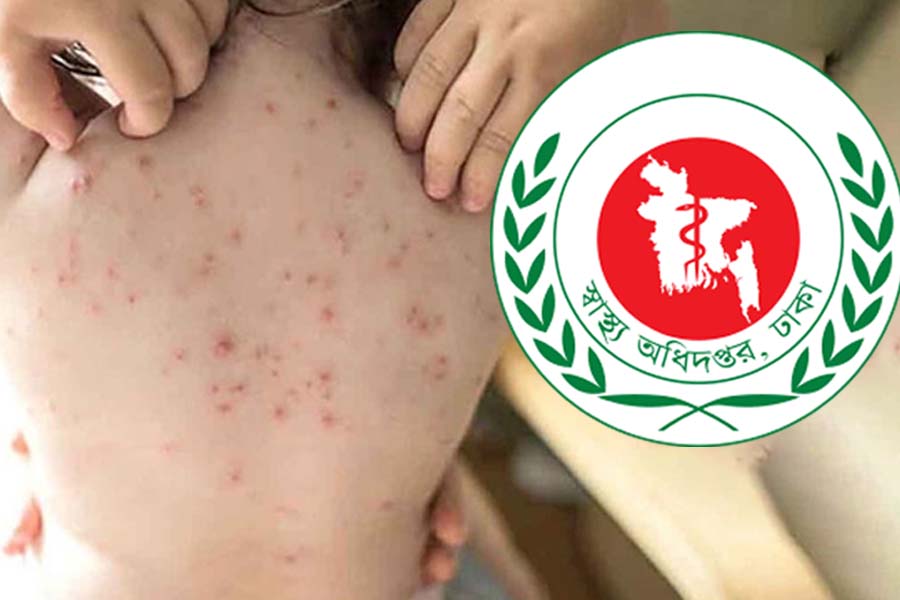 হামের উপসর্গ নিয়ে আরও ১০ মৃত্যু