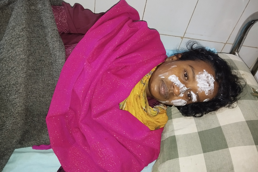 জুয়া খেলার টাকা না পেয়ে স্ত্রীর মুখ ঝলসে দিলো স্বামী