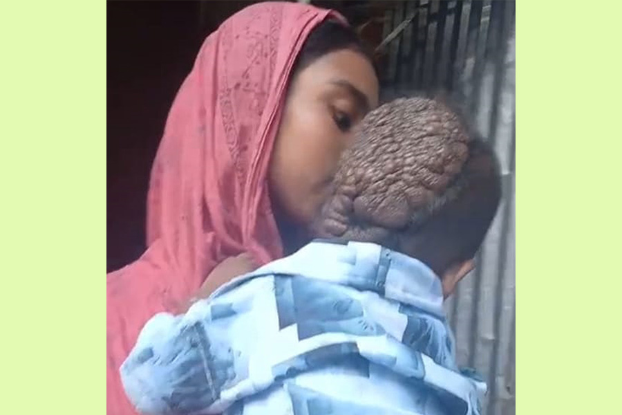বিরল রোগ সিফাতের মাথা জুড়ে বাসা বেঁধেছে
