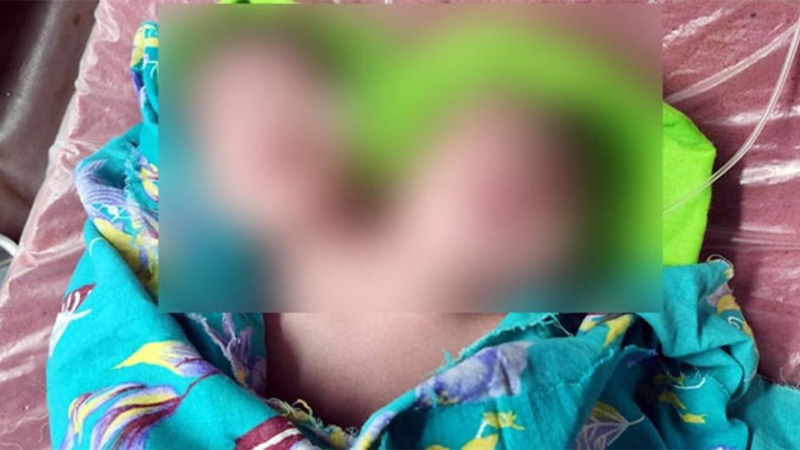 রাজশাহীতে দুটি মাথাসহ কন্যাশিশুর জন্ম