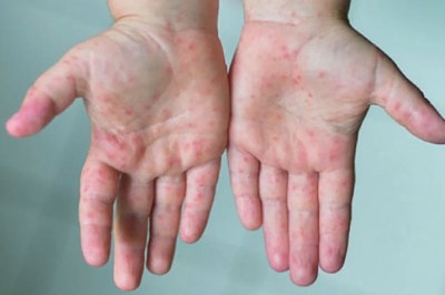 ২৪ ঘন্টায় হাম ও উপসর্গে ৯ জনের মৃত্যু