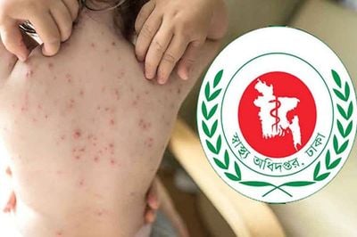 দেশে হামের উপসর্গে একদিনে ৯ শিশুর মৃত্যু