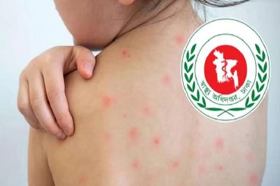 হাম ও হামের উপসর্গে আরও ৩ শিশুর মৃত্যু