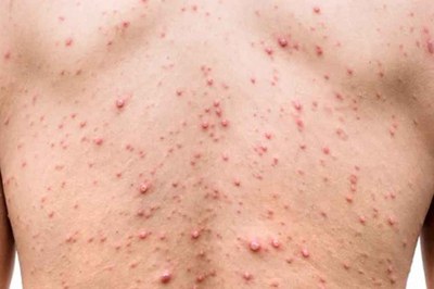 হাম ও হামের উপসর্গ নিয়ে আরও ৮ শিশুর মৃত্যু