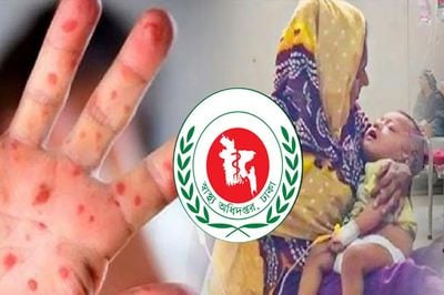 ২৪ ঘণ্টায় হাম ও উপসর্গে ৭ শিশুর মৃত্যু