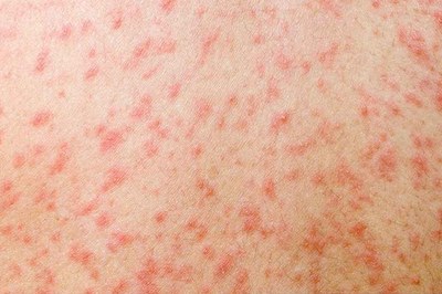 হাম ও হামের উপসর্গে সাত জনের মৃত্যু, নতুন রোগী ১৪ শতাধিক